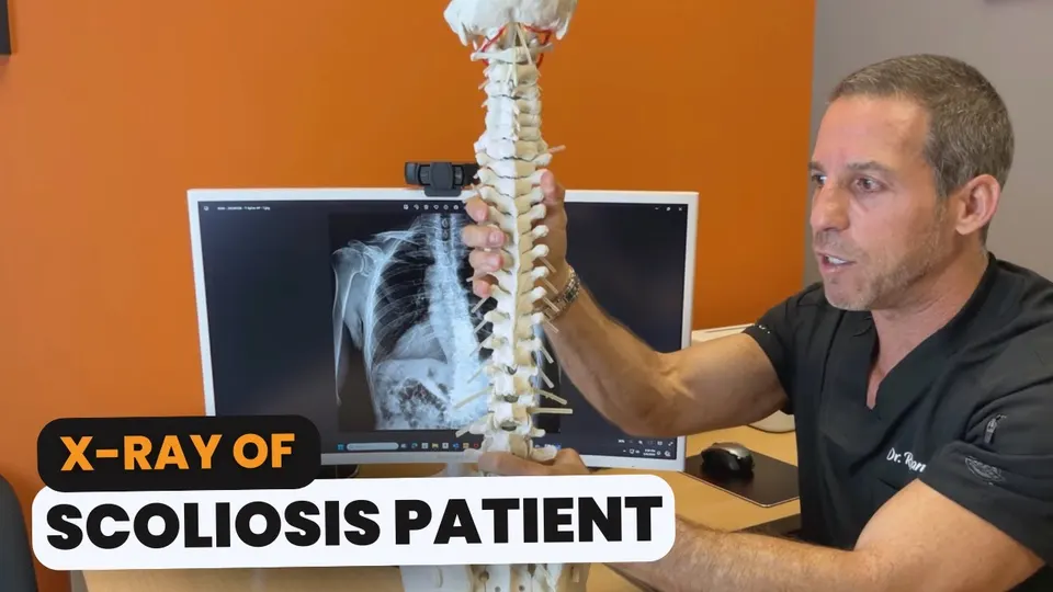 X-Ray of Scoliosis Patient