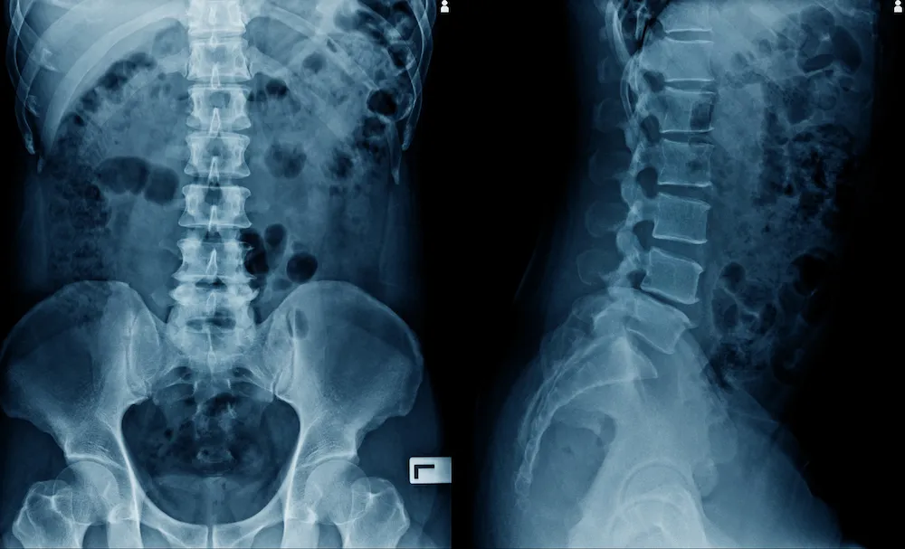 Front and side X-ray images of a lower spine